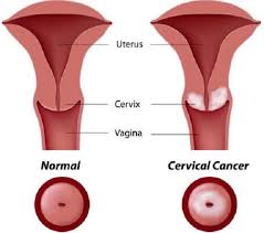 Cara lain untuk mencegah kanker serviks yaitu dengan melakukan vaksin hpv. Kanker Serviks Ciri Ciri Penyebab Dan Pencegahan Kanker Serviks Bidanku Com
