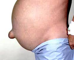 An umbilical hernia is the name for a small loop of your intestine bulging out of your belly button. Umbilical Hernia Repair Dr Ignatius Botha Surgeon