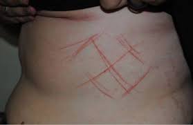 A suástica é um símbolo que representa o partido nazista e todos os males que ele defendia: Policia Indicia Jovem Marcada Com Suastica Advogada Diz Que Laudo Comprova Versao Da Vitima Sul 21