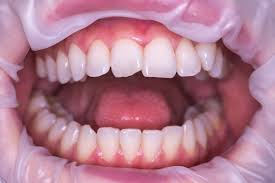 All you need have done is a tile restoration! Full Ceramic Crowns Cosmetic Dentistry Dental Treatments Abroad Dental Clinic Heraklion Crete