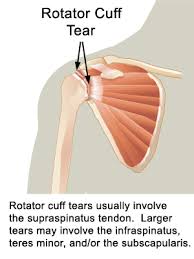 Image result for Rotator Cuff Tendonitis