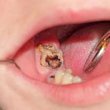 Mighty Dental Implants Cost New York City Teethwhiteningtips Toothimplant In 2020 Dental Implants Dental Extraction Dental Implants Cost
