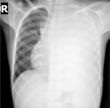 A doctor places a catheter inside the pleural cavity to drain fluid. Pleural Effusion Diagnosis Treatment And Management Abstract Europe Pmc