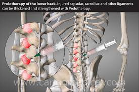It typically results in inflammation of the sacroiliac joint, and can be debilitating. Sacroiliac Joint Dysfunction Symptoms And Treatment Options Caring Medical Florida