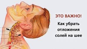 как избавиться от отложения солей на шее в домашних условиях Dlya Zdorovya Zdorove Tovary Dlya Zdorovya Muzhskoe Zdorove