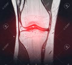 Musculoskeletal radiology south texas radiology group. A Snapshot Of The Diagnosis Of An Mri Of The Knee In Which Arthrosis Stock Photo Picture And Royalty Free Image Image 141961734