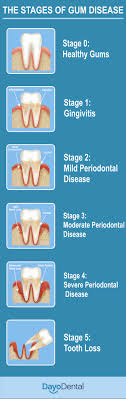Your Ultimate Guide To Periodontal Disease Periodontitis