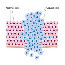 In some cases, only the ovary with cancer may be removed. Ovarian Cancer Medlineplus Genetics