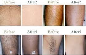 Laser clinics australia (marrickville metro shopping centre). Laser Hair Removal The Beauty And Cosmetic Clinic 70 Pitt St