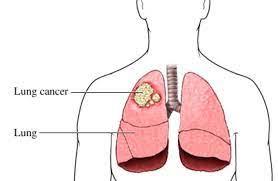 Maybe you would like to learn more about one of these? Tanda Tanda Awal Kanser Paru Paru Pada Lelaki Dan Wanita Yang Ramai Tidak Tahu