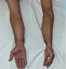 Image result for Liposarcoma