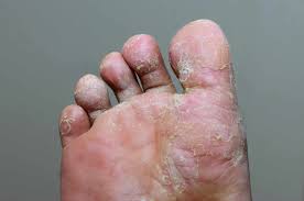 types of fungal foot infections jaws