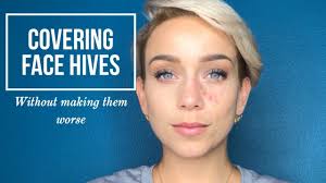 What do i do? answered by dr. Covering Hives On Your Face Youtube