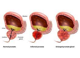 We did not find results for: Enlarged Prostate Bph Dr Roshan Patel