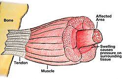 Image result for Compartment Syndrome