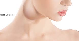 Potential causes of a lump on the neck include swollen lymph nodes, acne, and cysts. Neck Lumps Ent Surgery Brandon Hitchcock Tauranga