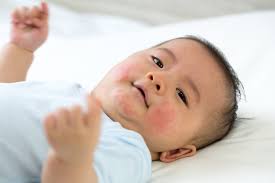 My Baby Has Red Spots On Their Face What Should I Do Kinedu Blog