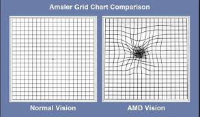 Amsler Grid Chart Comparison Macular Degeneration Grid