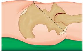 The examiner draws an imaginary line from the anterior superior iliac spine to the ischial tuberosity on the same side of the hip/pelvis. Jaypeedigital Ebook Reader