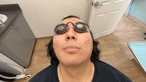 ✨𝐄𝐑𝐁𝐈𝐔𝐌 𝐅𝐀𝐂𝐈𝐀𝐋 𝐏𝐄𝐄𝐋✨, 𝕎𝕙𝕒𝕥 𝕚𝕤 𝕚𝕥?, Erbium facial  peel helps to remove the top layer of skin (epidermis) causing regrowth to  the tissues (re epithelialization) which helps:, -to soften fine lines and  ...