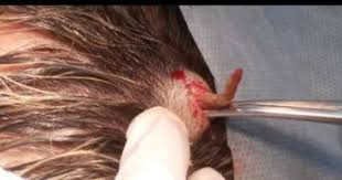 Pin On Ingrown Hair