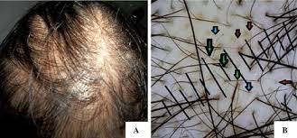 When a person feels tingling, burning, or irritation of the scalp, they are more likely to agitate the scalp in a bid to stop the pain. A 37 Years Old Woman With Diffuse Hair Loss B Scalp Dermoscopy Showing Download Scientific Diagram