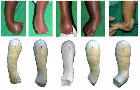 Start studying ponseti method for clubfoot. Ponseti Method Physiopedia