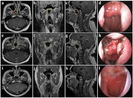 When they do appear, symptoms can look a lot like those of many. Minimally Invasive Surgery Alone Compared With Intensity Modulated Radiotherapy For Primary Stage I Nasopharyngeal Carcinoma Cancer Communications Full Text
