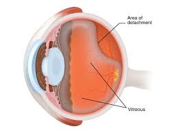 Is this normal to get different kind of floaters. Floaters And Flashes Video South Bay Ophthalmology