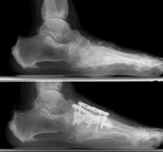 Image result for XRay Changes in Rheumatic Conditions
