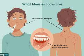 Measles Prevention