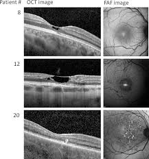 Ophthalmology On Twitter Due To Lack Of Macular Pigment In Pts With Sjogren Larsson Syndrome Phototoxic Damage May Cause Macular Degeneration Marked By Pseudocysts Young Adult Patients May Proceed To An Early Onset End Stage Macular