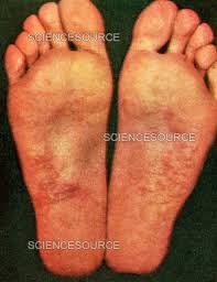 Image result for pompholyx soles of feet