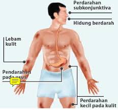 Pesakit akan diberikan ubat demam dan dinasihatkan berehat serta digalakkan minum air. Blog Safeni Feni Cara Menaikkan Platelet Darah Semasa Demam Denggi