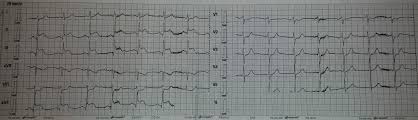 Check spelling or type a new query. Infarct Miocardic Acut Inferior
