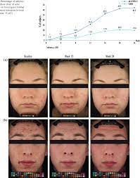Your acne scars will fade over time—but these creams and serums can speed things up. Figure 3 From Prevention And Reduction Of Atrophic Acne Scars With Adapalene 0 3 Benzoyl Peroxide 2 5 Gel In Subjects With Moderate Or Severe Facial Acne Results Of A 6 Month Randomized Vehicle Controlled Trial Using