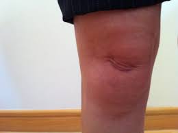 Wondering what's wrong with your knee? The Infrapatellar Hoffa S Fat Pad Explained Claire Patella