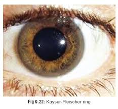 Image result for Copper Poisoning