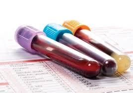 A cbc may be done to help diagnose certain blood cancers, such as leukemia and lymphoma. Blood Test May Detect Tumor Derived Dna In Early Stage Cancers Ons Voice