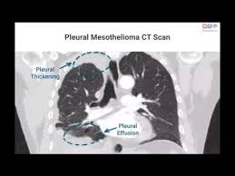 The key is to find the most effective actions to take, out of the overwhelming maze of cancer fighting treatments you can find on the internet or hear from friends. 4 Peritonealis Rak Hpv Vacino Torino