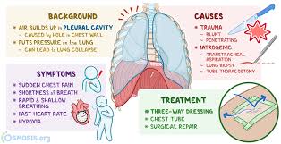 Image result for Pneumothorax