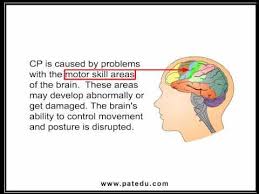 Cerebral Palsy Use With Out Of My Mind By Sharon Draper Child Development Teaching Summer Learning Programs Family And Consumer Science