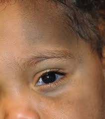 Image result for melanosis sclera