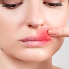 Bei lippenbläschen wird aus etwas heilerde und kaltem wasser ein brei angerührt und dieser dann mit einem wattestäbchen auf die lippe aufgetragen. Was Hilft Gegen Herpes Praktische Tipps Stern De