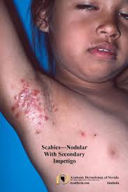 Image result for scabies human children