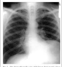 Mesothelioma is a deadly cancer of the lungs most often caused by. Localized Benign Pleural Mesothelioma A Case Report Semantic Scholar