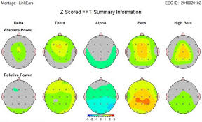 Image result for Postconcussion Syndrome
