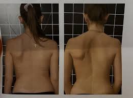 Image result for Winged Scapula