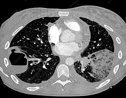 Image result for Lung Abscess