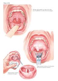 Allergic Conditions Of Pharynx Manifestations Of An Allergic Background May Present Themselves In The Pharynx As Subcutaneous Tissue Conditioner Soft Palate